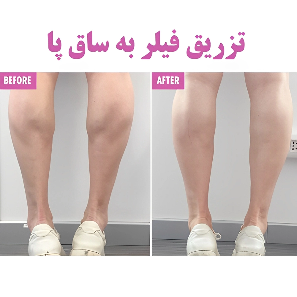 تزریق فیلر بادی به ساق پا