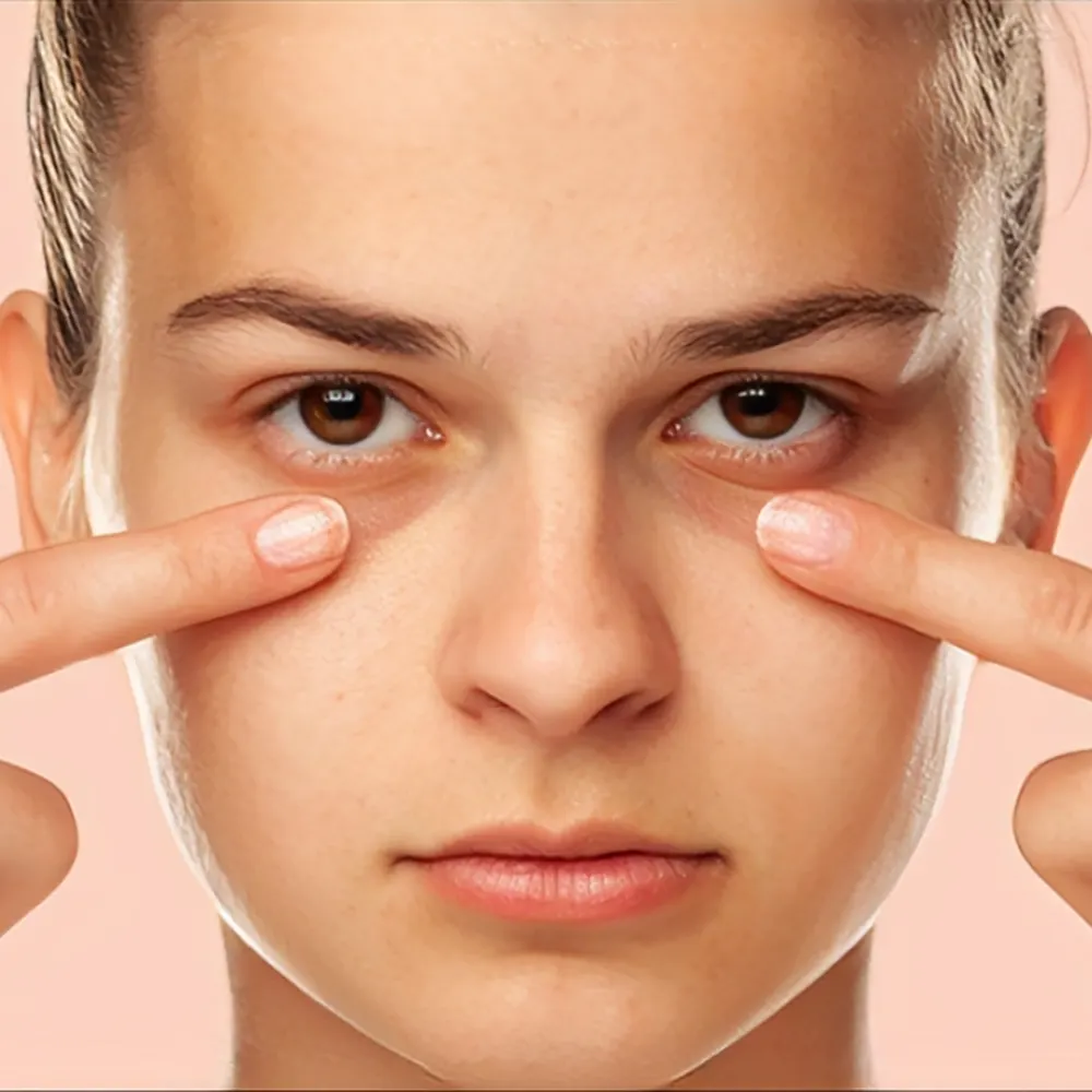 از بین بردن ورم زیر چشم بعد از تزریق ژل