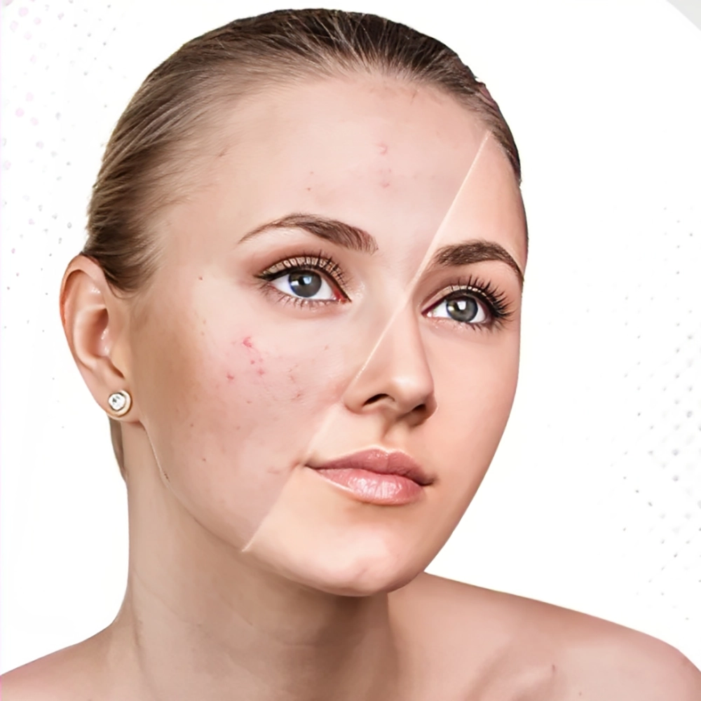 درمان لک با مزوتراپی