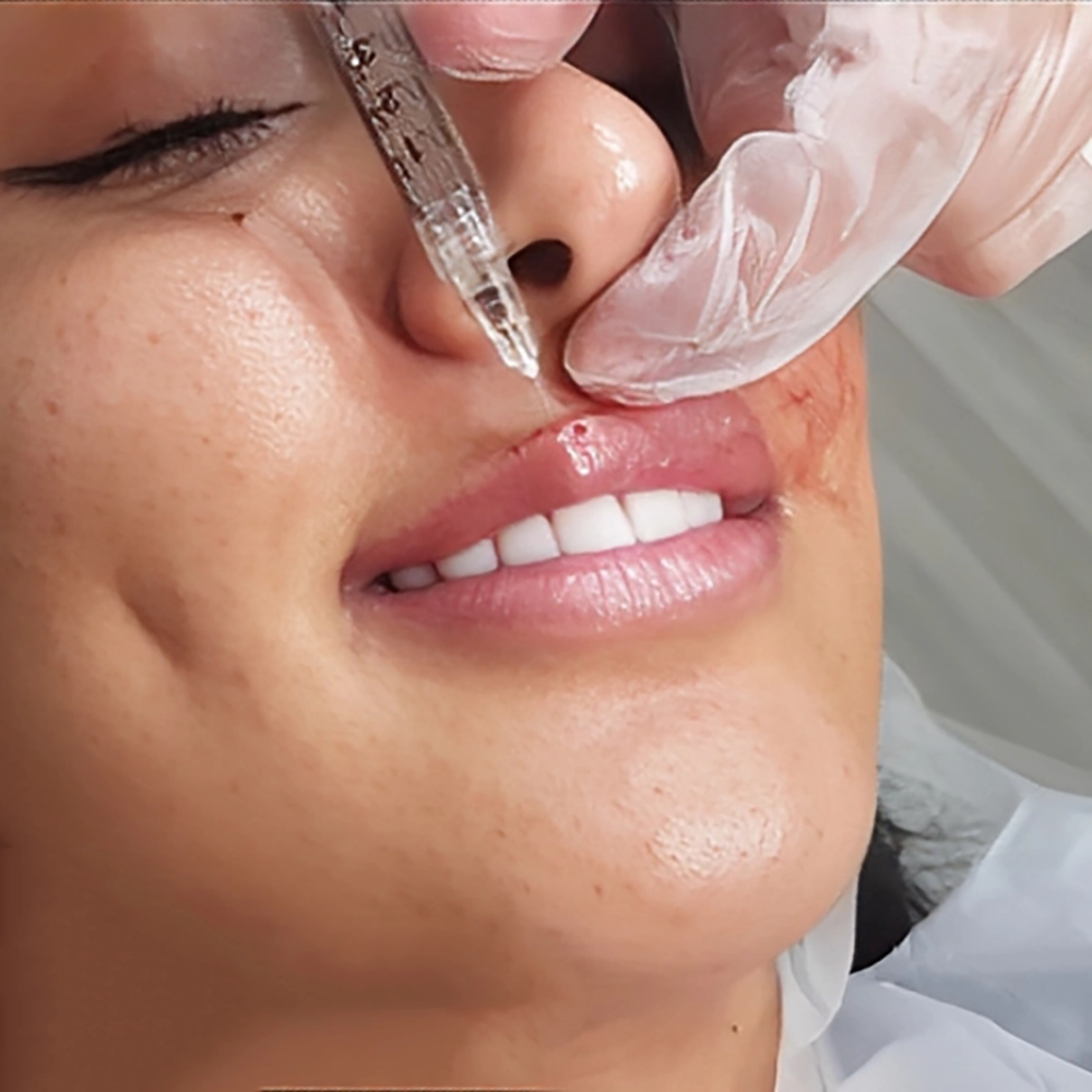 پماد بی حسی قوی برای تزریق ژل لب