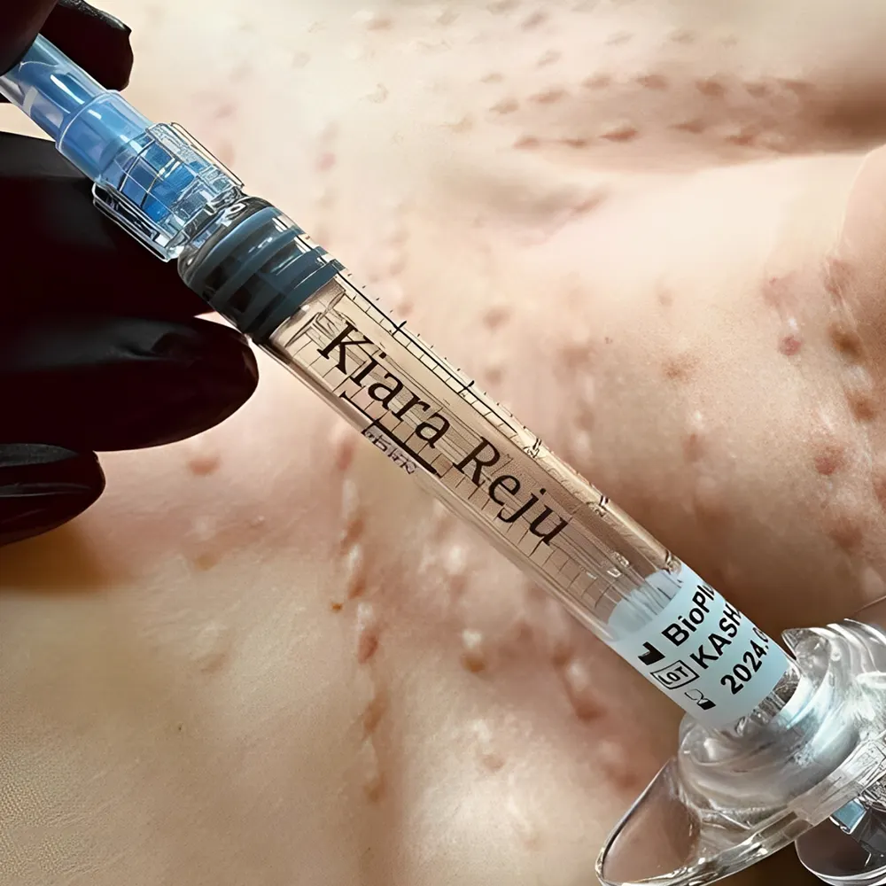 نحوه تزریق مزوژل کیارا