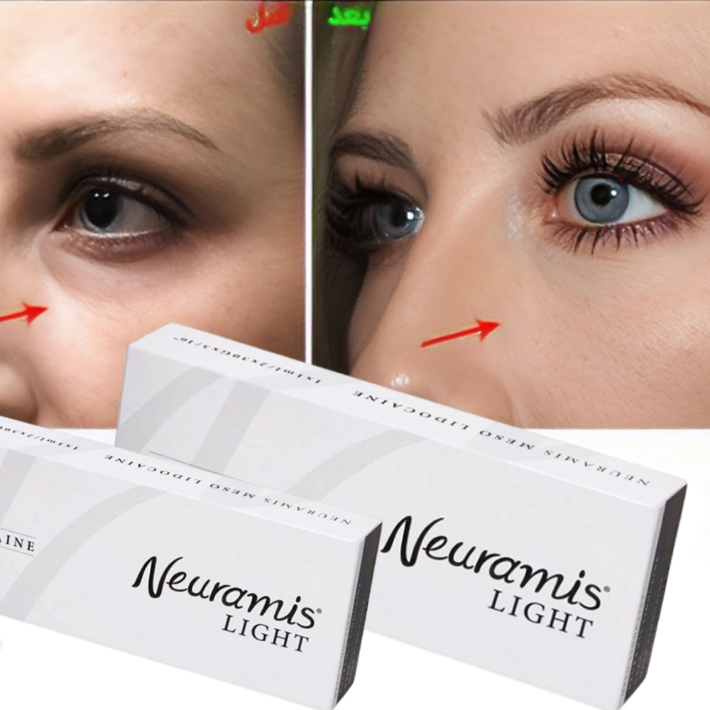 ماندگاری فیلر زیر چشم نورامیس