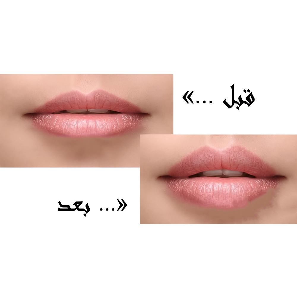 راهنمای کامل حجم‌ دهی و شکل‌ دهی لب‌ ها با فیلر لب