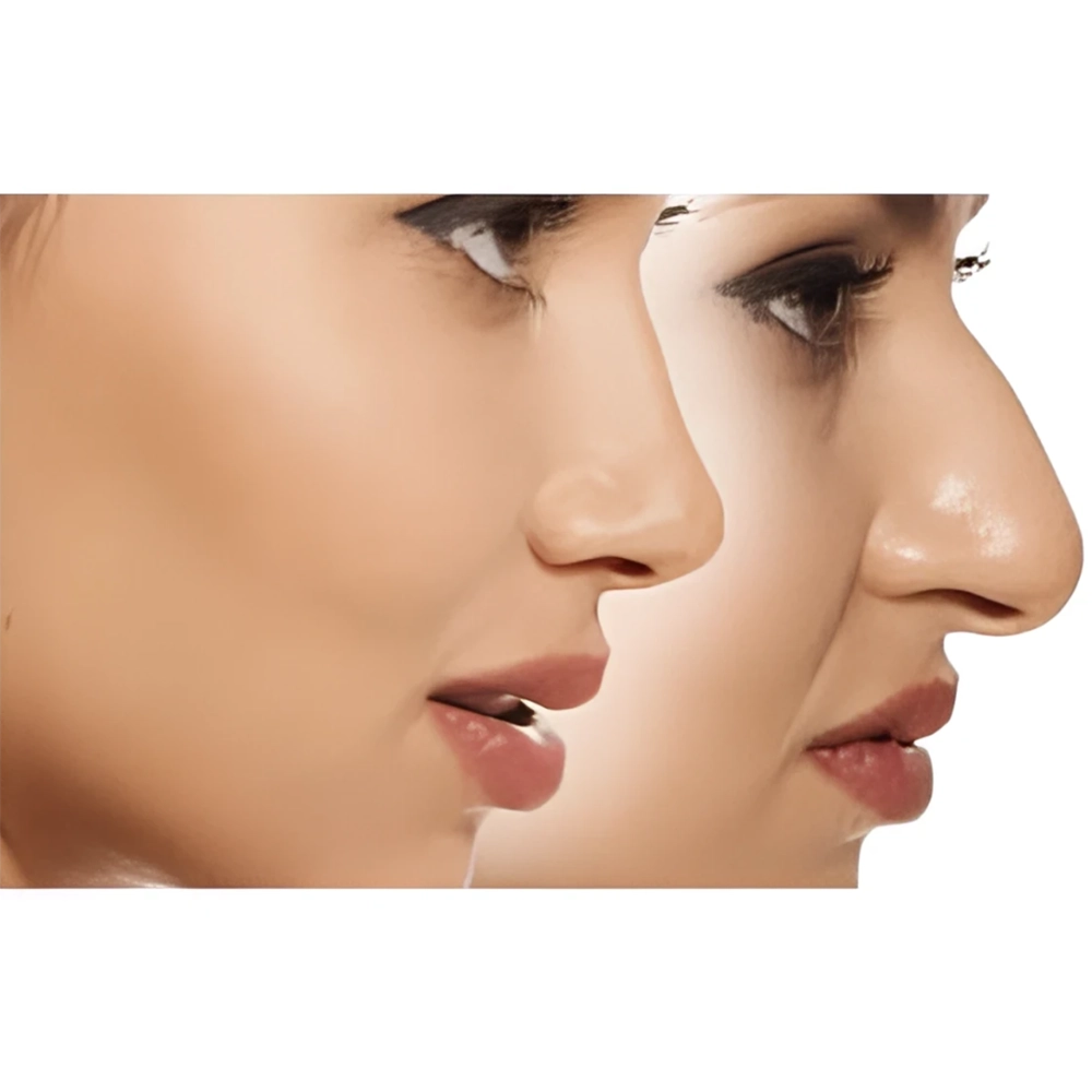 اصلاح فرم بینی بدون جراحی با فیلر بینی