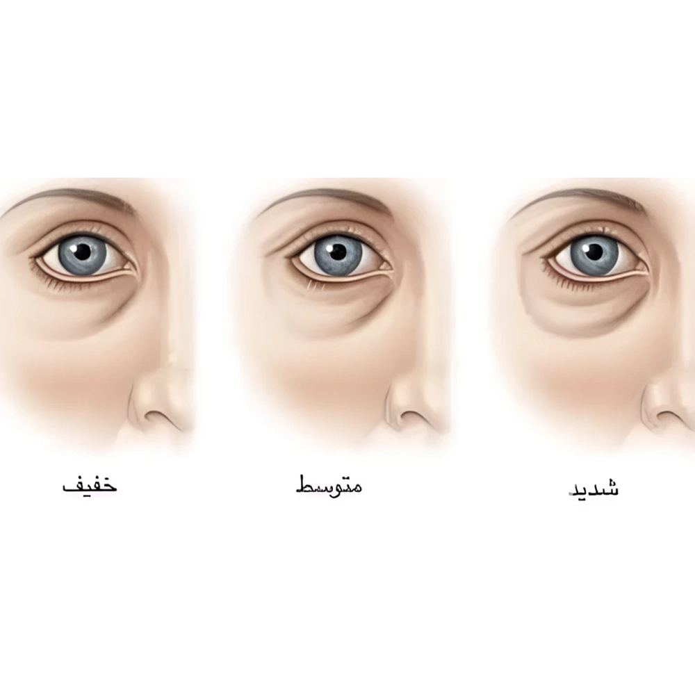 درمان قطعی تیرگی و گودی با فیلر زیر چشم