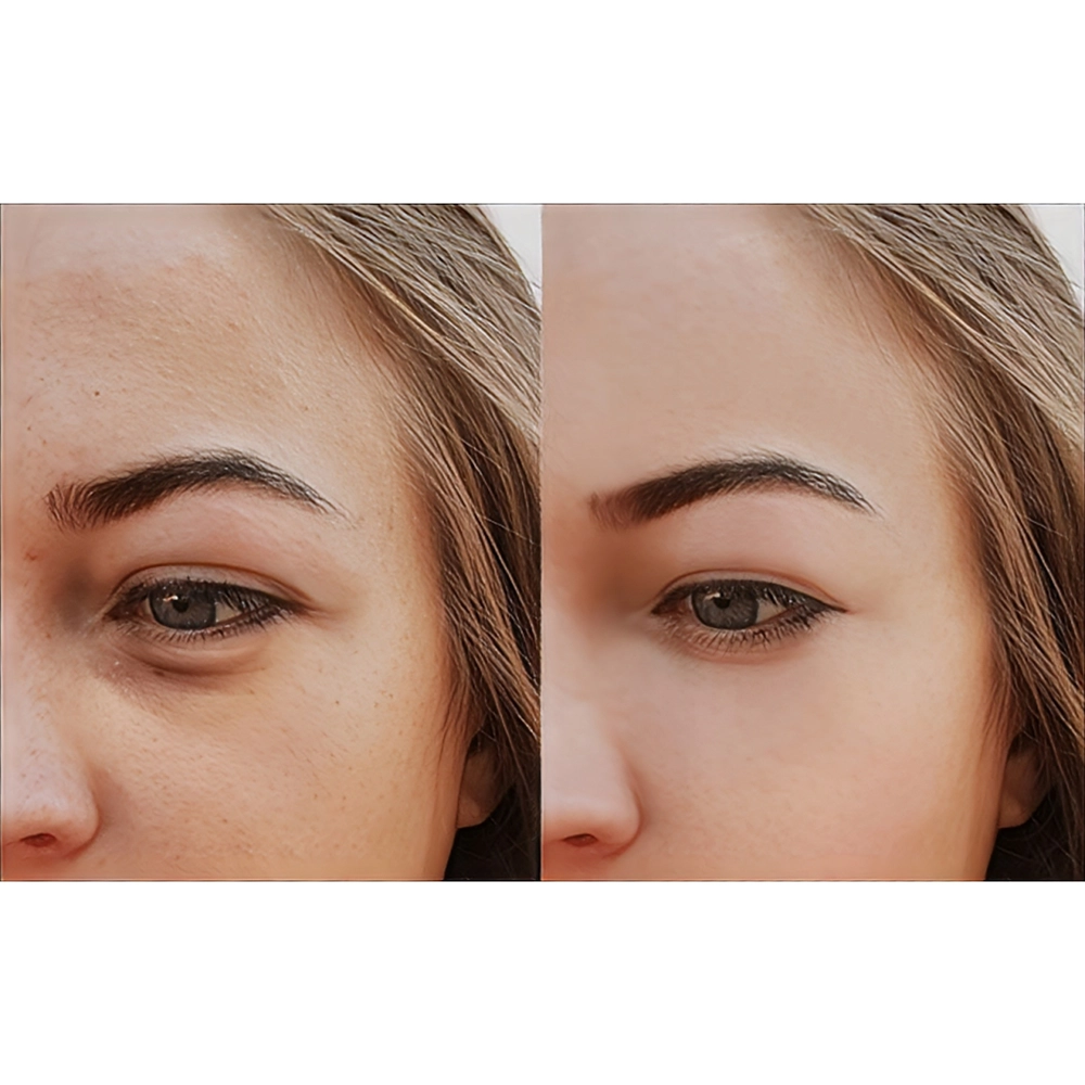 خطرات فیلر زیر چشم و نحوه پیشگیری