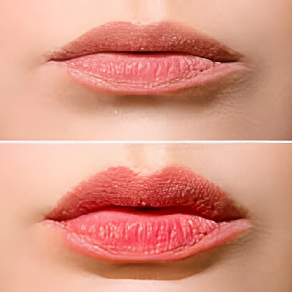 اصلاح نامتقارنی لب‌ ها با فیلر