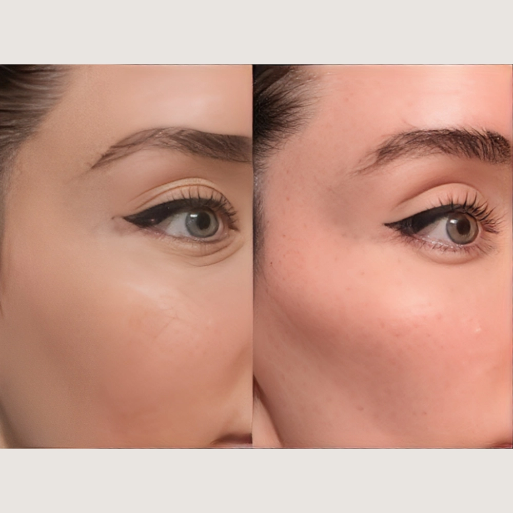 ترکیب فیلر با سایر روش‌ های زیبایی