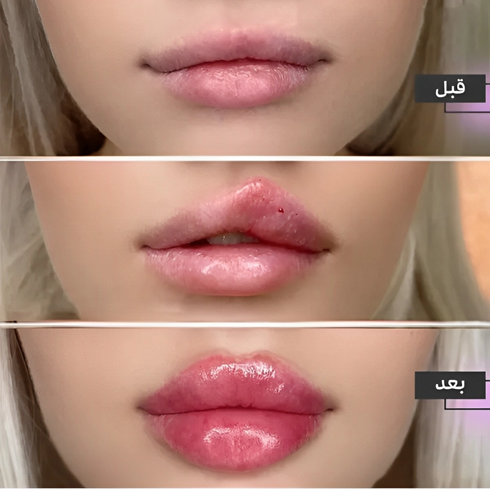 چه زمانی میتوان نتیجه نهایی فیلر را دید؟