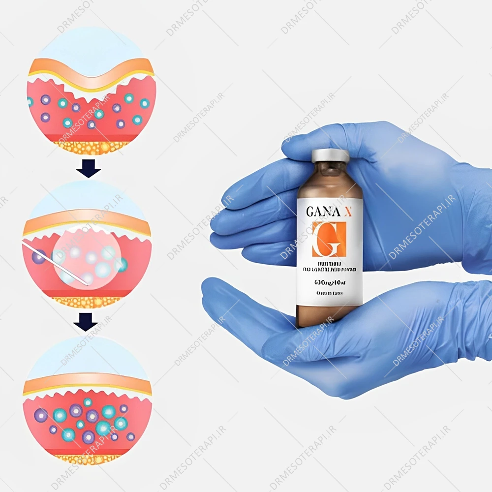 ژل فیلر بدن گانا x